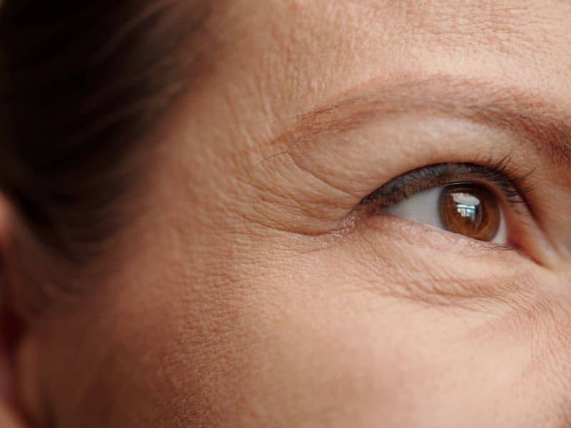 arrugas bajo los ojos y ácido hialurónico