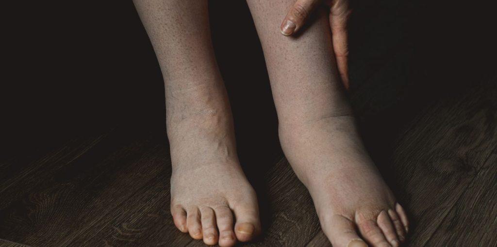 diferencias entre lipedema y linfedema