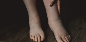 diferencias entre lipedema y linfedema