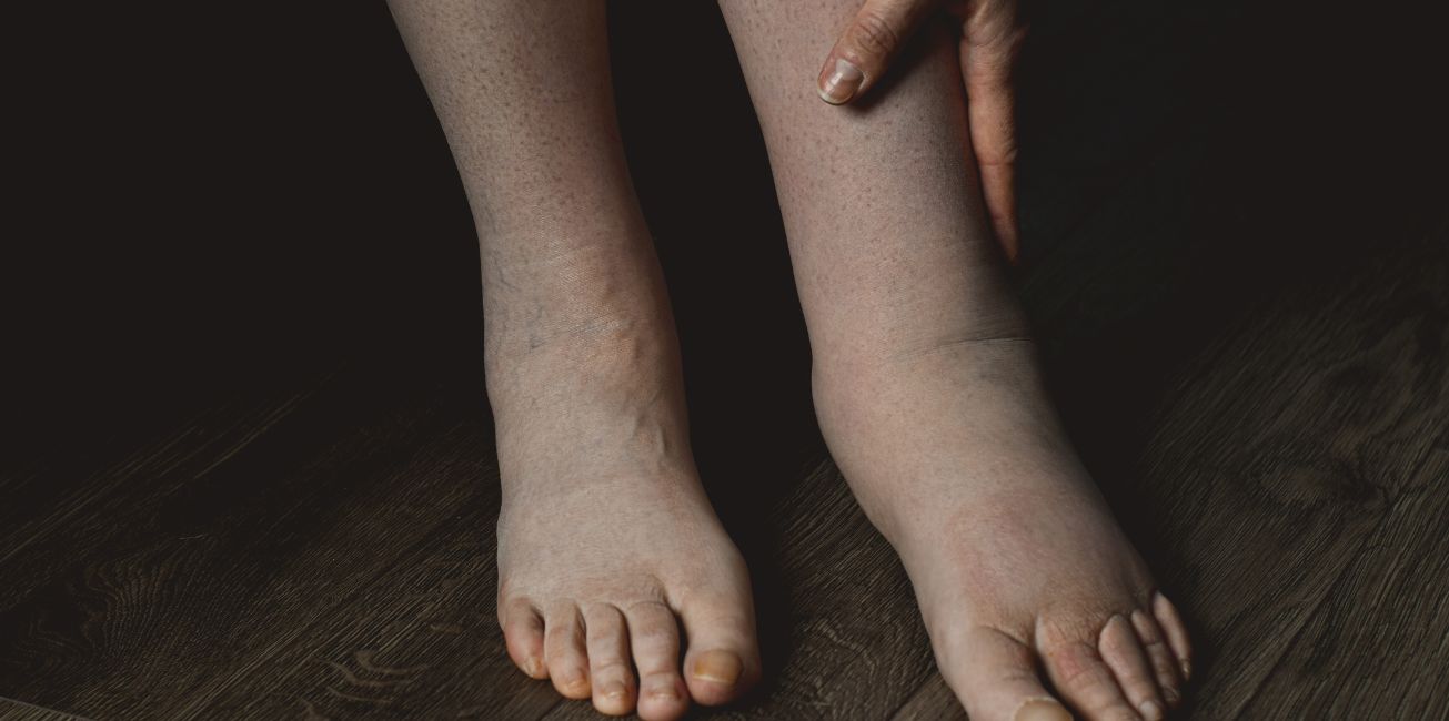 diferencias entre lipedema y linfedema
