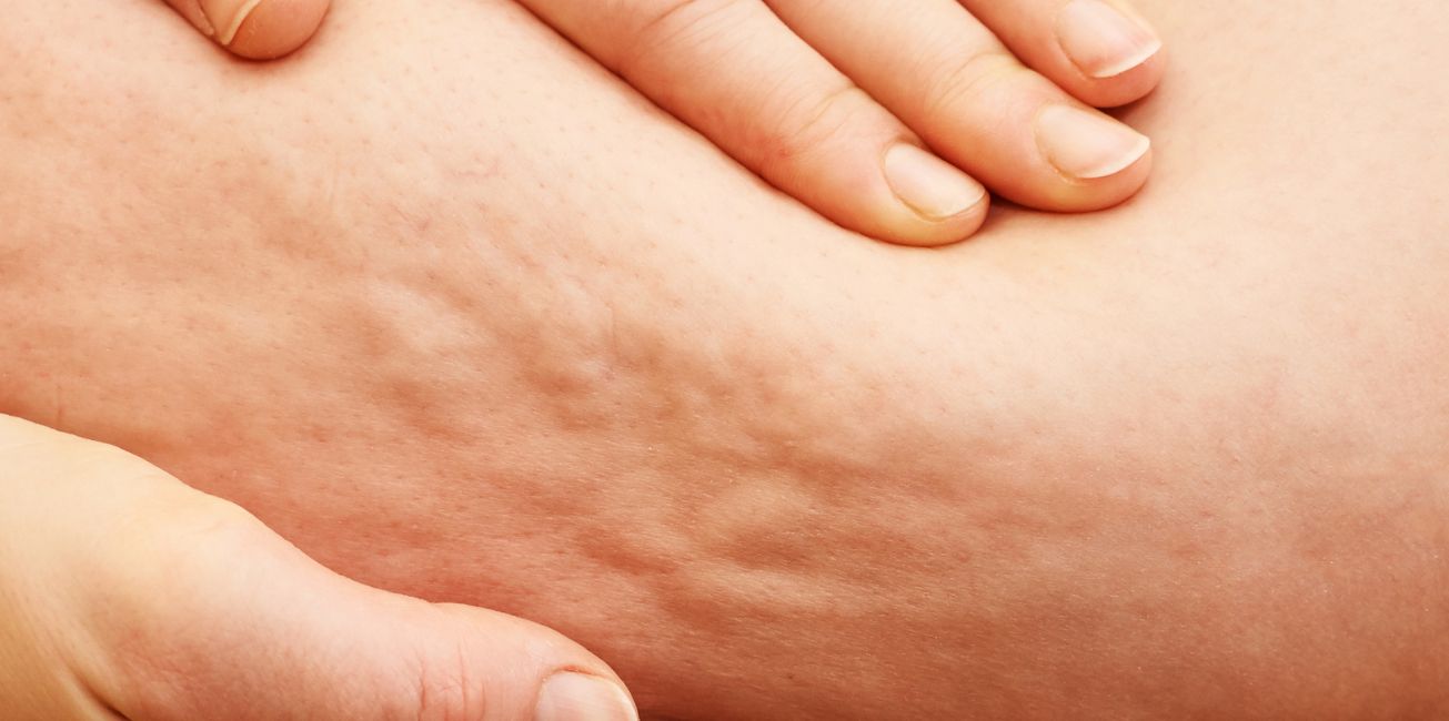 muslo con lipedema