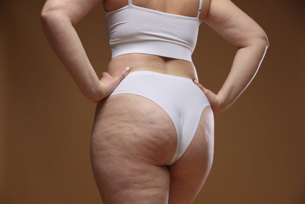 como saber si tengo lipedema